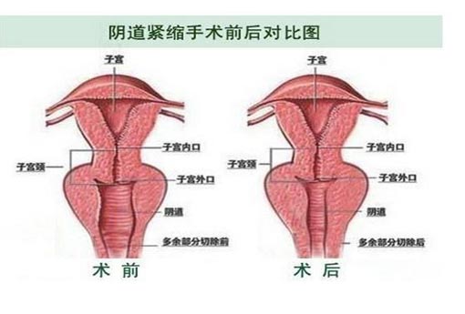 缩阴_两性知识