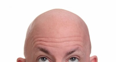 Baldness 秃头的烦恼